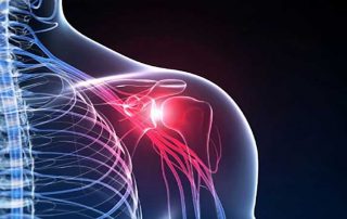 درمان شانه درد ، درد شانه