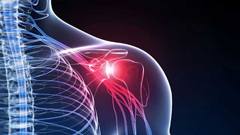 درمان شانه درد ، درد شانه