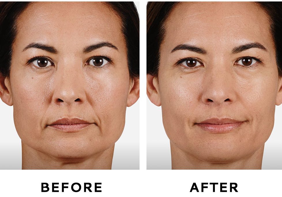 جوانسازی پوست با طب سوزنی