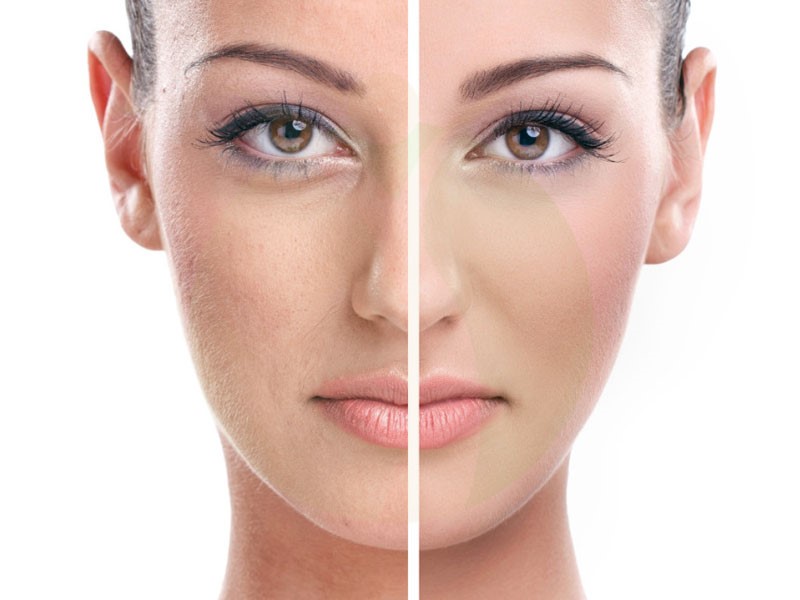 درمان جای جوش