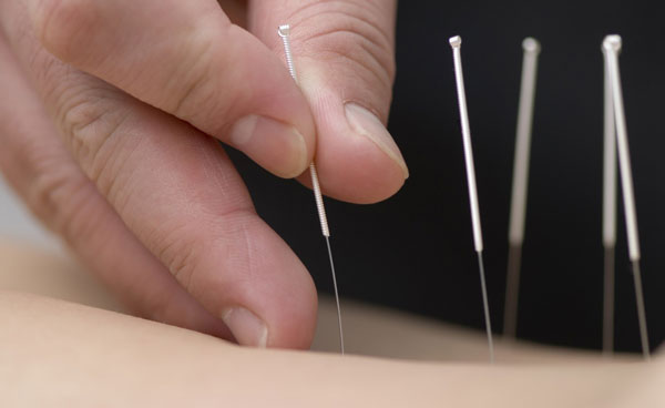 متخصص طب سوزنی