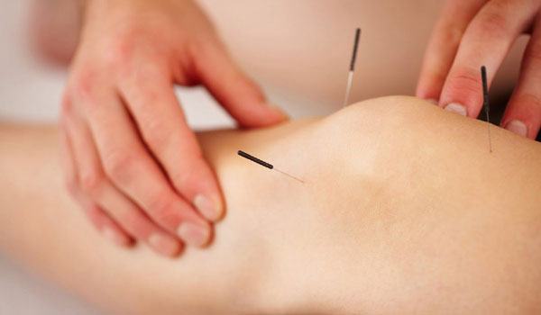 طب سنتی ، بهترین دکتر طب سوزنی