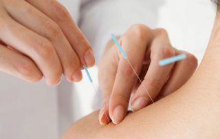 طب سوزنی در اصفهان