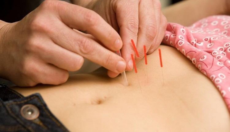 درمان ناباروری با طب سوزنی