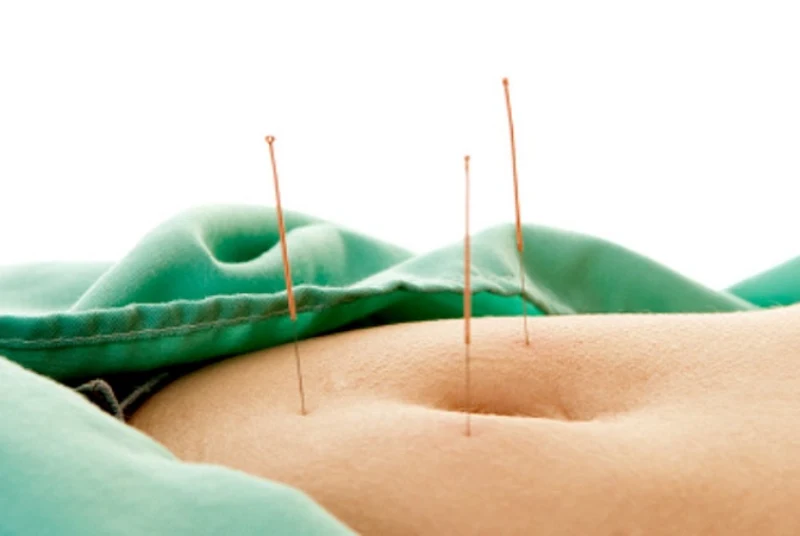 درمان روده تحریک پذیر با طب سوزنی