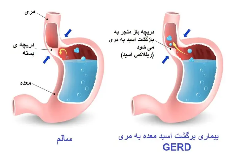درمان رفلاکس معده به مری با طب سوزنی